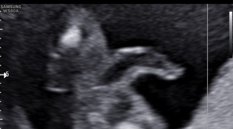 Congenital Megalourethra - pic 1
