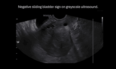 UOG videoclip: Prediction of vesicouterine adhesions by transvaginal ...
