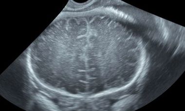 Megalencephaly.jpg