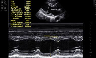 Preeclampsia banner.JPG