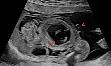 US guided fetal techniques.png 1