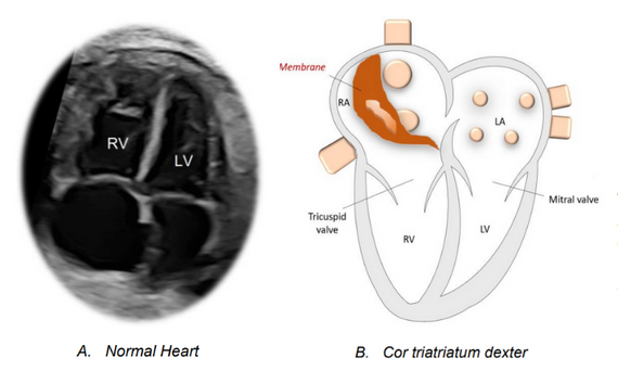 cor triatriatum dexter vs normal heart scan image diagram