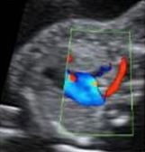 Aberrant Right Subclavian Artery