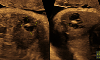 Hepatic Hemangioma.png