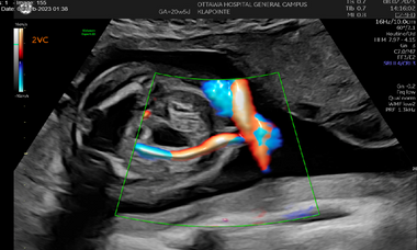 Vascular abnormalities of the umbilical cord.png