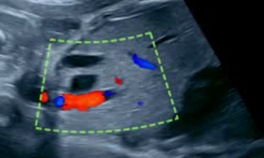 Hepatic cyst.png