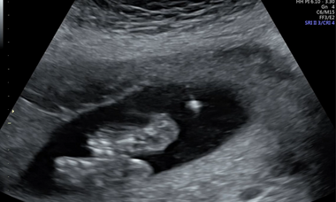 Amniocentesis.png