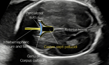 Fetal Neurosonography - website thumbnail.png