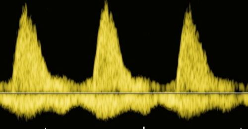 Abnormal Rate and Rhythm