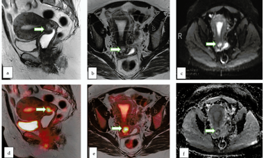 Gynecological malignancies course image.png 1