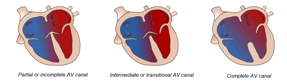 illustration of heart showing three times of septal defects