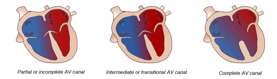 illustration of heart showing three times of septal defects