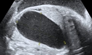 Pyloric atresia.jpg