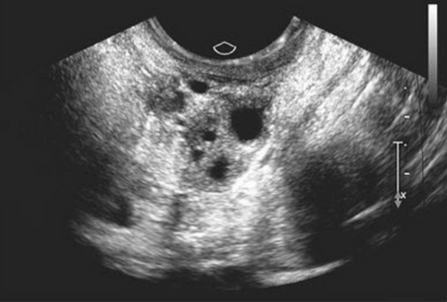 PCOS Awareness Month 2025: read, learn and share resources