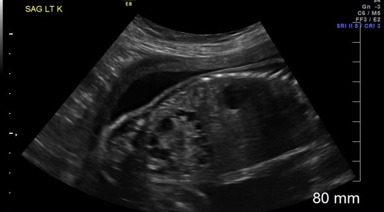 Ectopic Kidneys 2.jpg