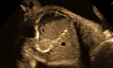 Meconium pseudocyst.png