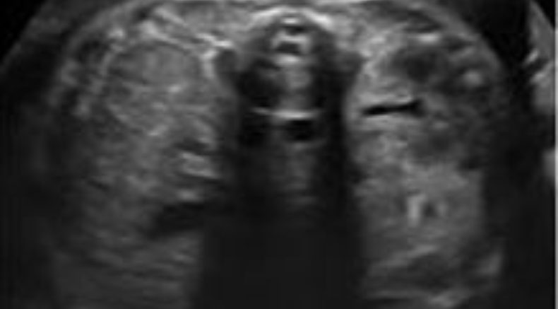 Unilateral renal agenesis main pic.JPG