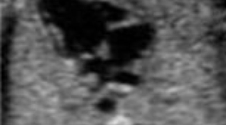 Single ventricle main pic.JPG