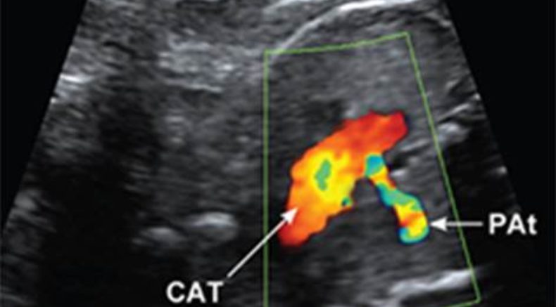 Truncus arteriousus.jpg Fetal anomalies 2017