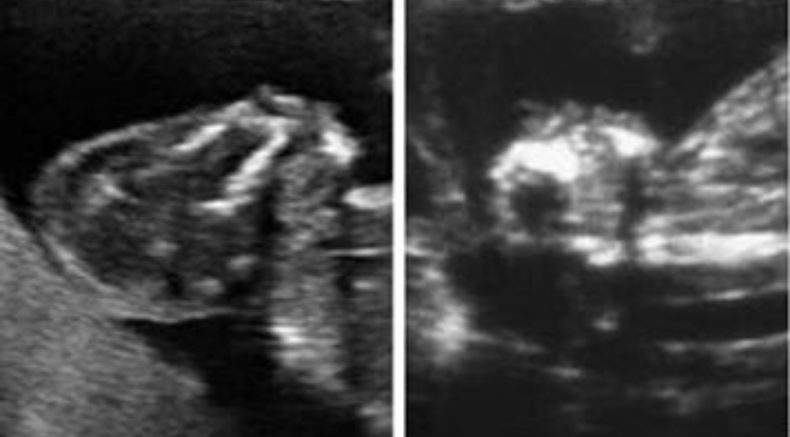 anencephaly main pic.JPG