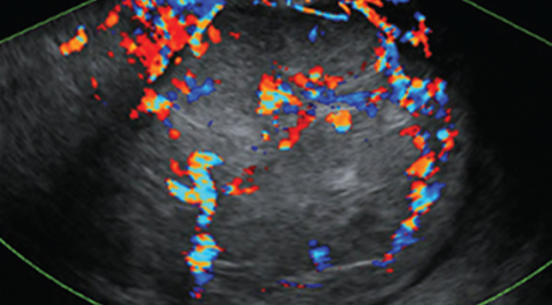  Gyne course Doppler_leiosarcoma_anterior uterine wall.png