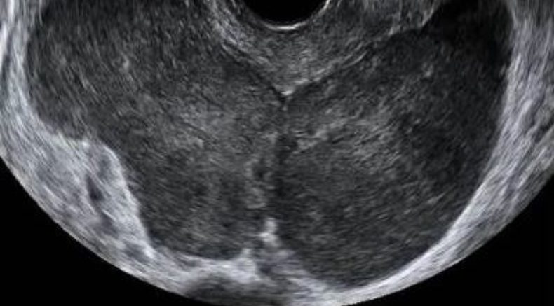 Metastases to the ovary main pic.JPG