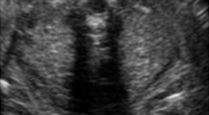 Bilateral renal agenesis main pic.JPG