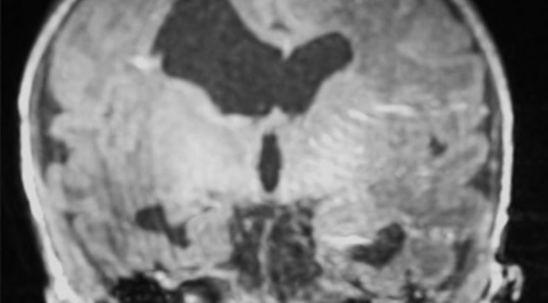 ventriculomegaly_MRI.jpg