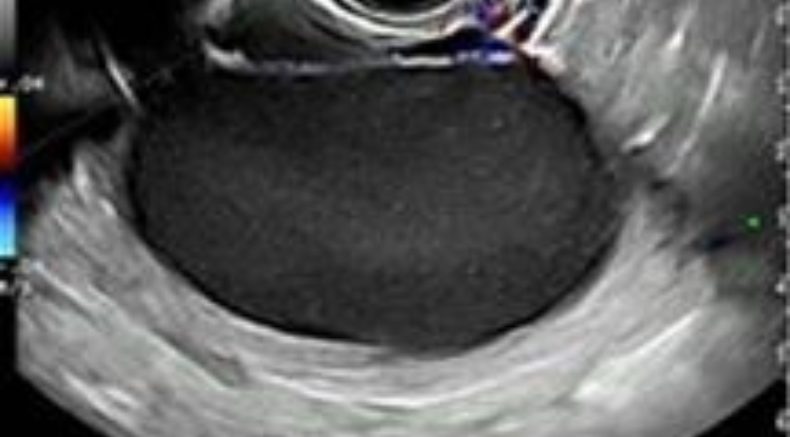 Endometriomas main pic.JPG