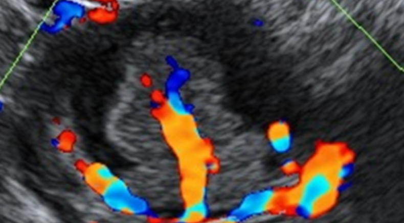  Gyne course Doppler seroum borderline tumor.png