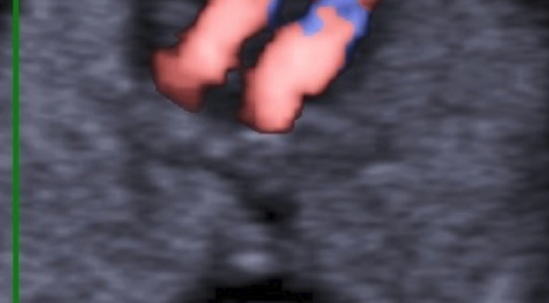 Normal heart.jpg.png 1st tri