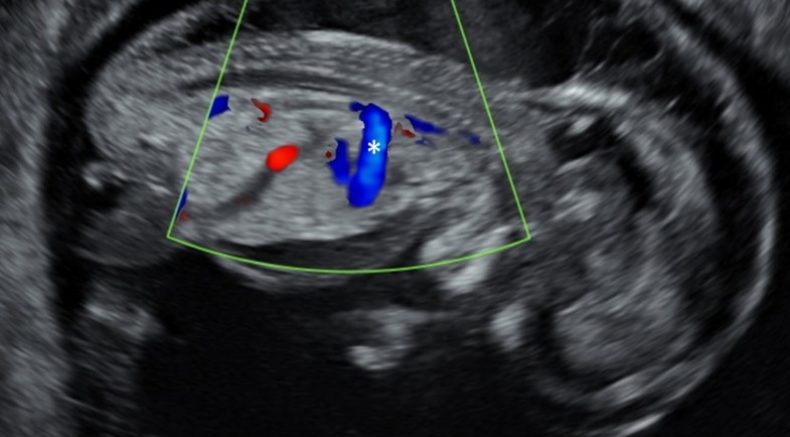 Pulmonary valve syndrome and trisomy 18.jpg 1st tri