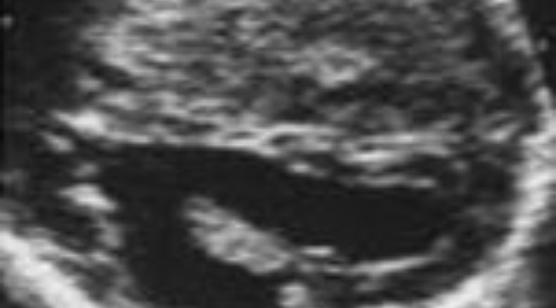 Schizencephaly main pic.JPG