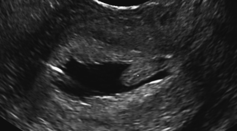  Gyne course focal lesion_saline contrast sonohysterography.png