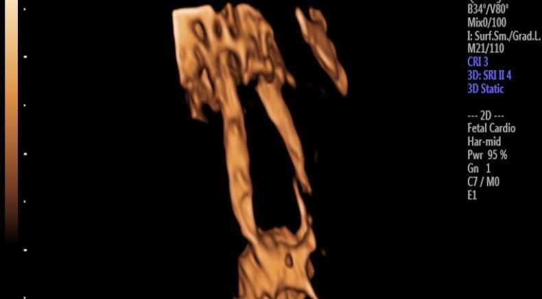 Choledochal Cysts.jpg