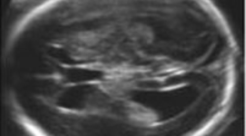 Mild Ventriculomegaly main pic.JPG