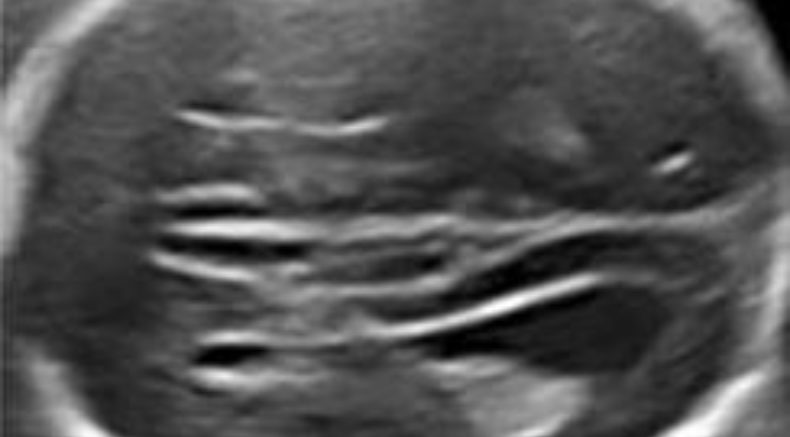 Agenesis of the corpus callosum main pic.JPG
