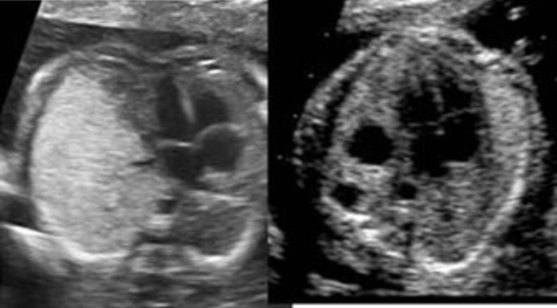 Echogenic lungs main pic.JPG
