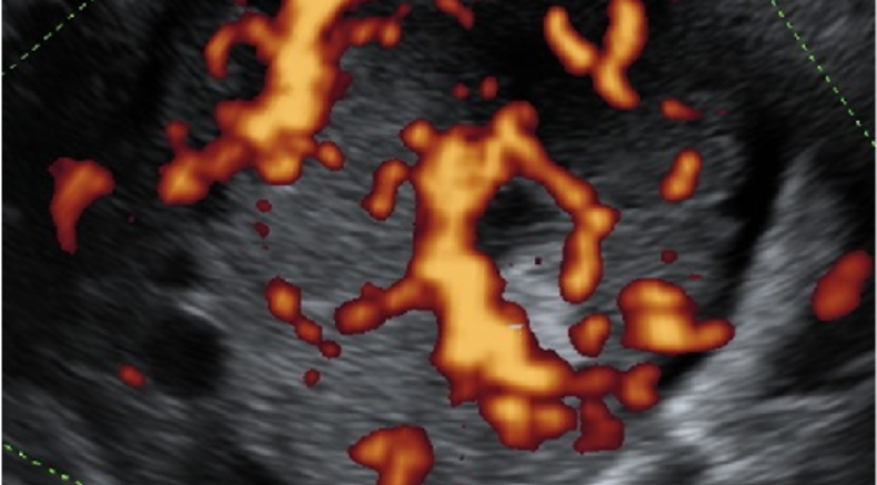  Gyne course endometroid tubal cancer stage IA.png