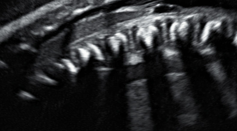 24 weeks 5th ventricle and spinal nerves.jpg
