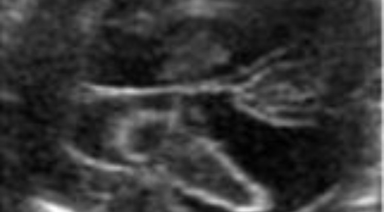 Intracranial Hemorrage main pic.JPG