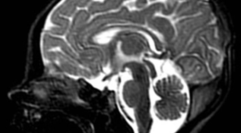 posterior fossa anomaly_MRI.jpg
