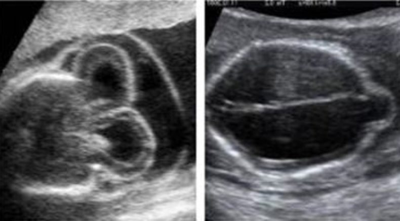 Cephalocele main pic.JPG
