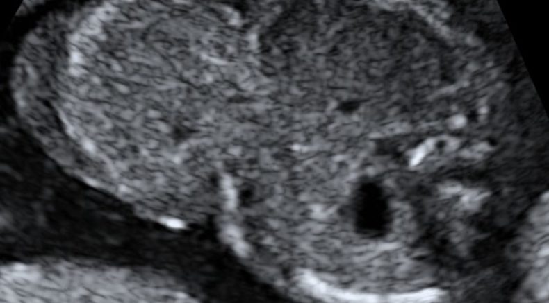 Omphalocele main pic.jpg
