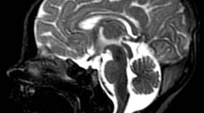 Posterior fossa abnormality.jpg