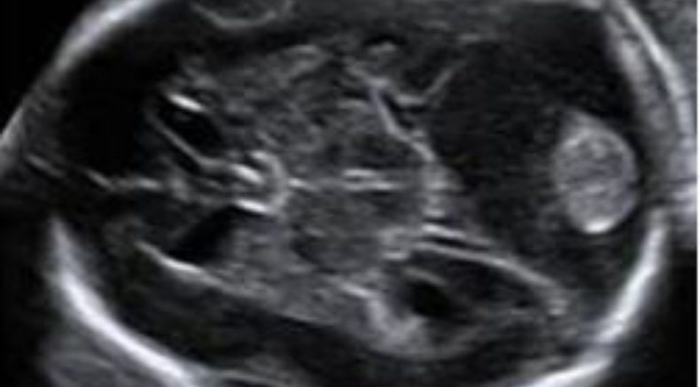 Dural Sinuses thrombosis main pic.JPG