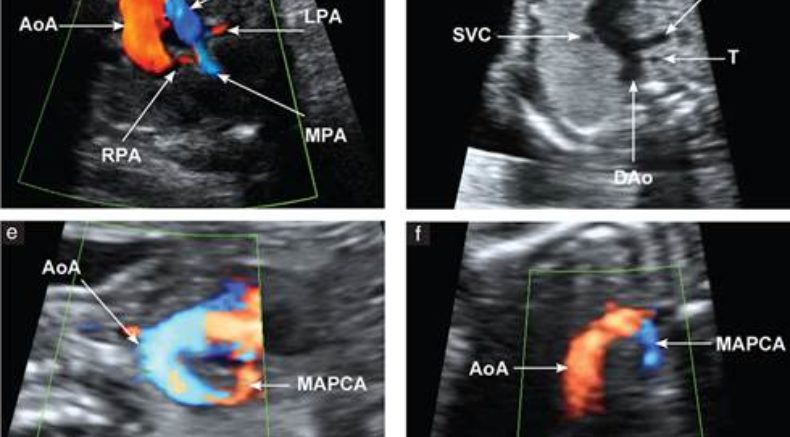 Truncus arteriosus2.jpg Fetal anomalies 2017