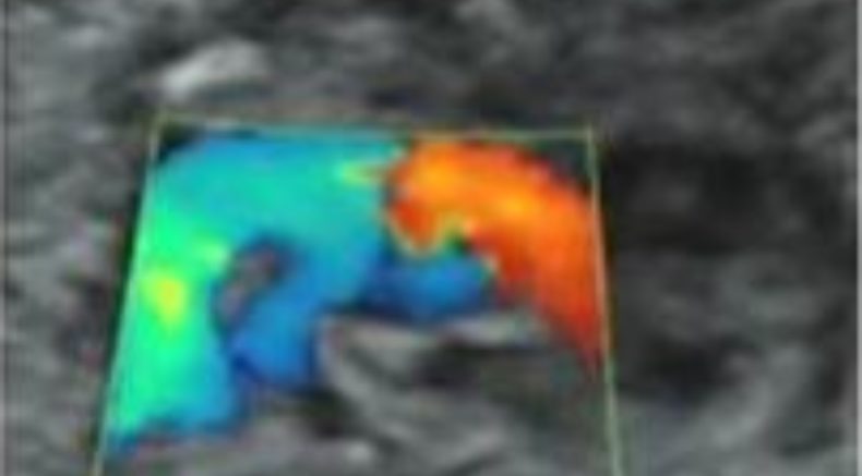 Common arterial trunk main pic.JPG