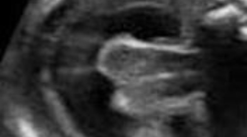 Holoprosencephaly title image.jpg