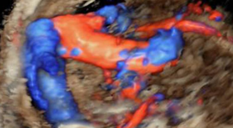 vein of Galen_3D color Doppler.jpg